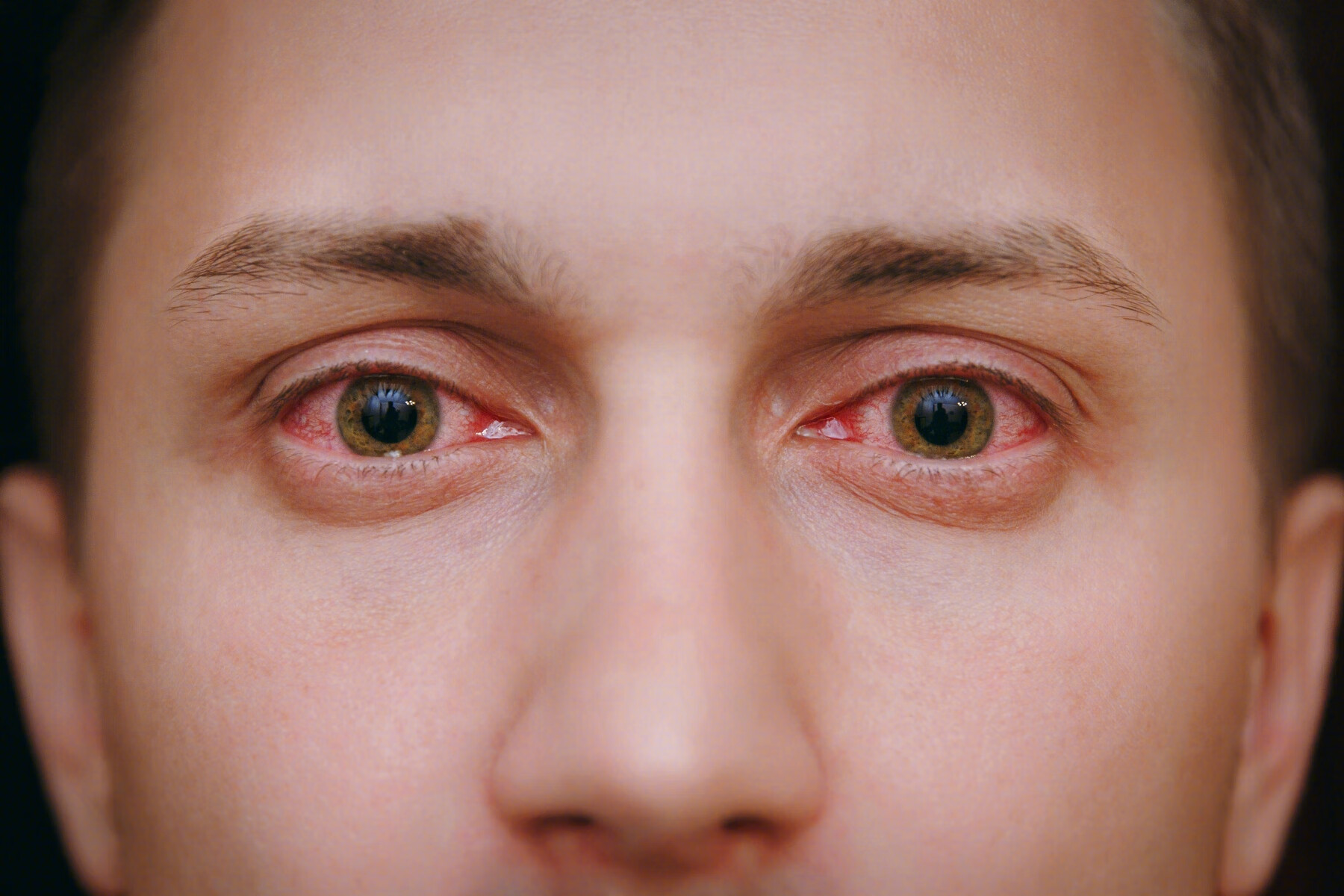 一张图区别常见眼红（结膜炎、巩膜炎、虹睫炎炎、结膜下出血） - 知乎