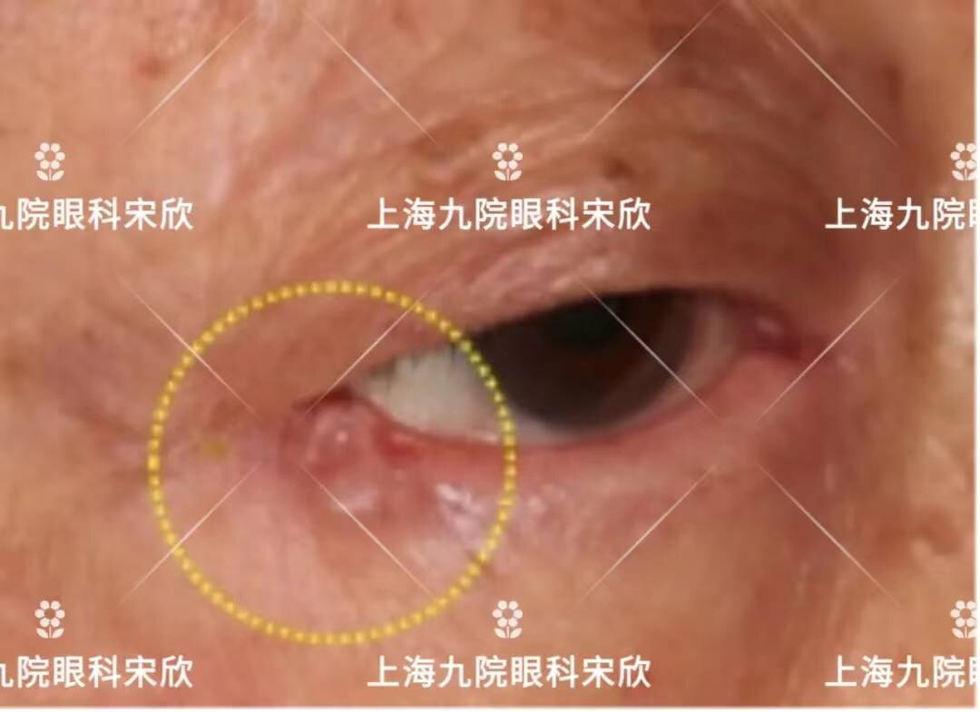 眼球后面长了肿瘤图片图片