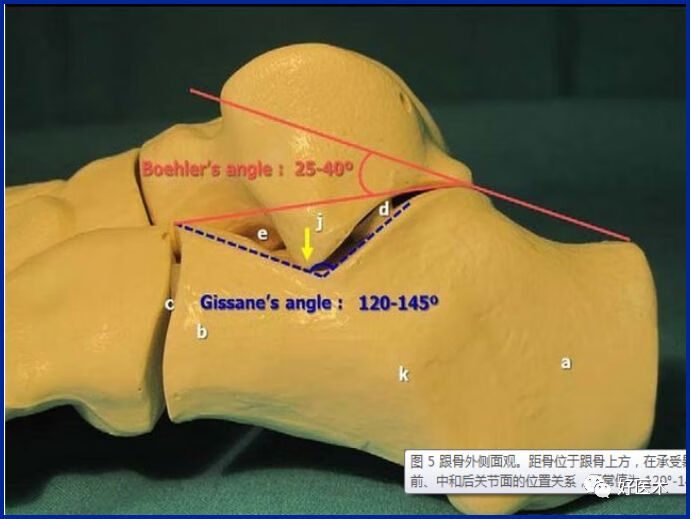 跟骨骨折解剖图图片