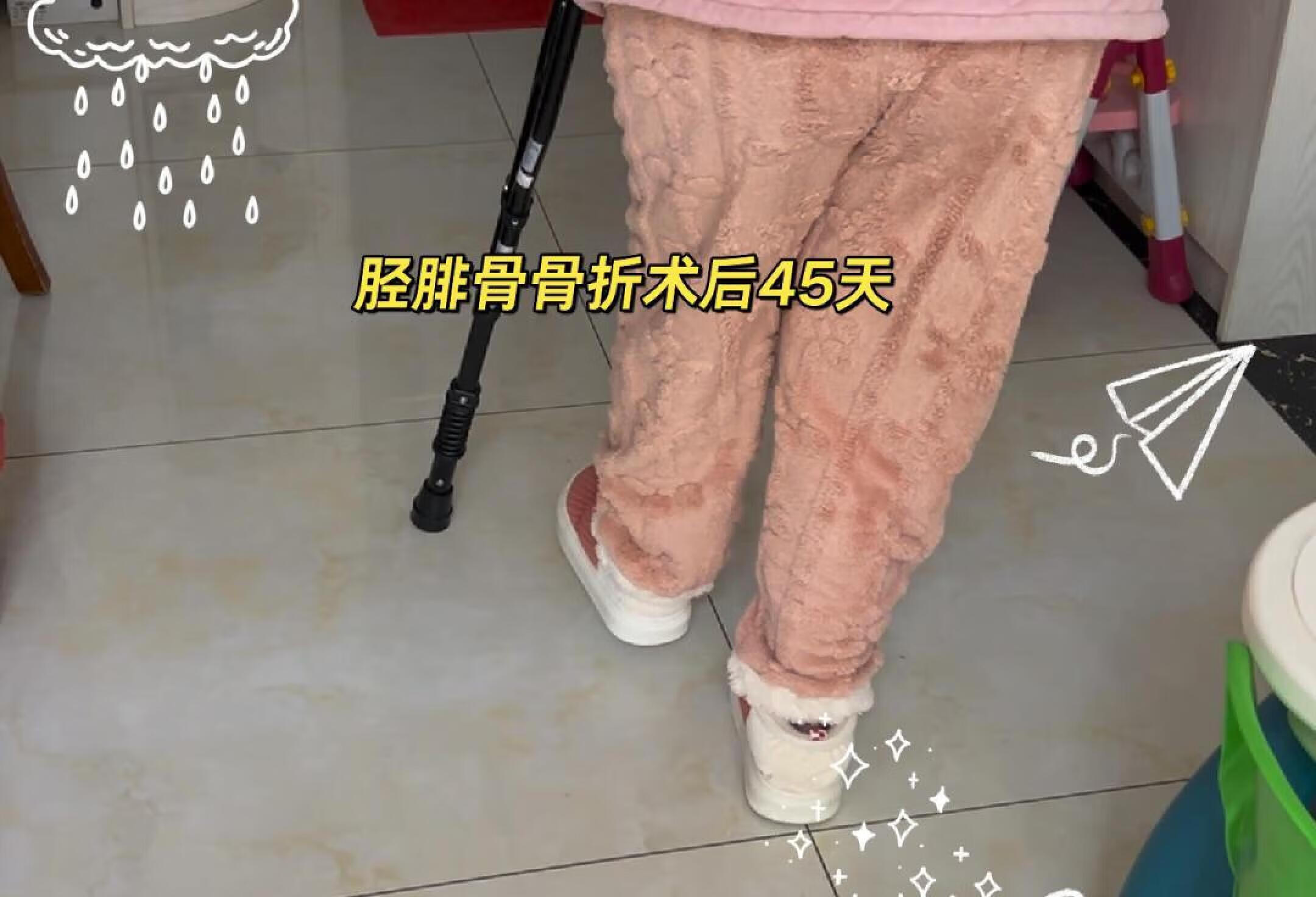 胫腓骨骨折术后45天