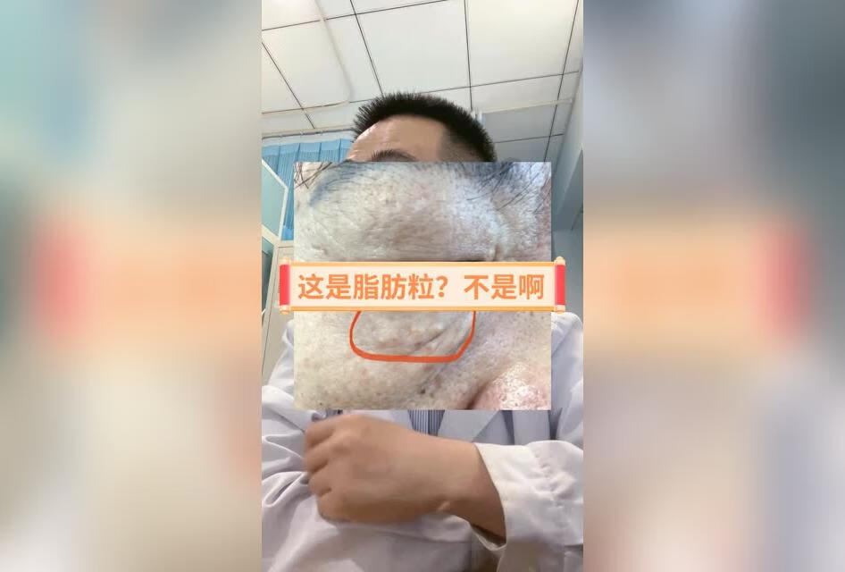 你以为眼睛下方的是脂肪粒，当然不是，它是汗管瘤 