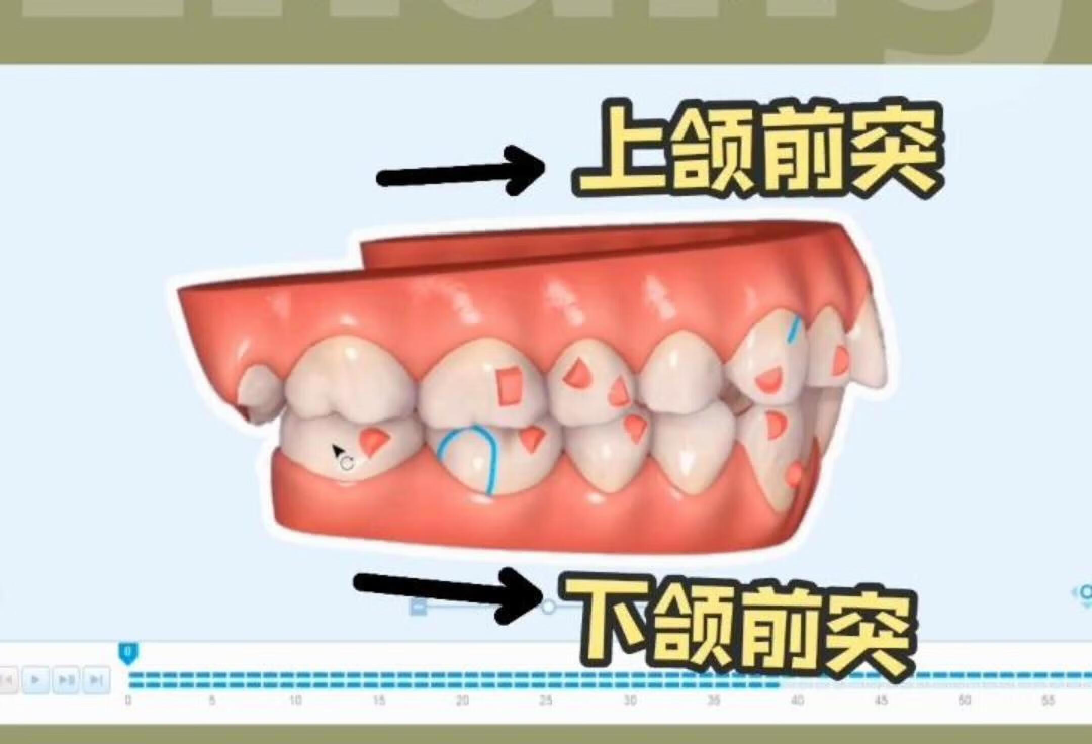 真人牙套方案|双颌前突，拔牙矫正❗