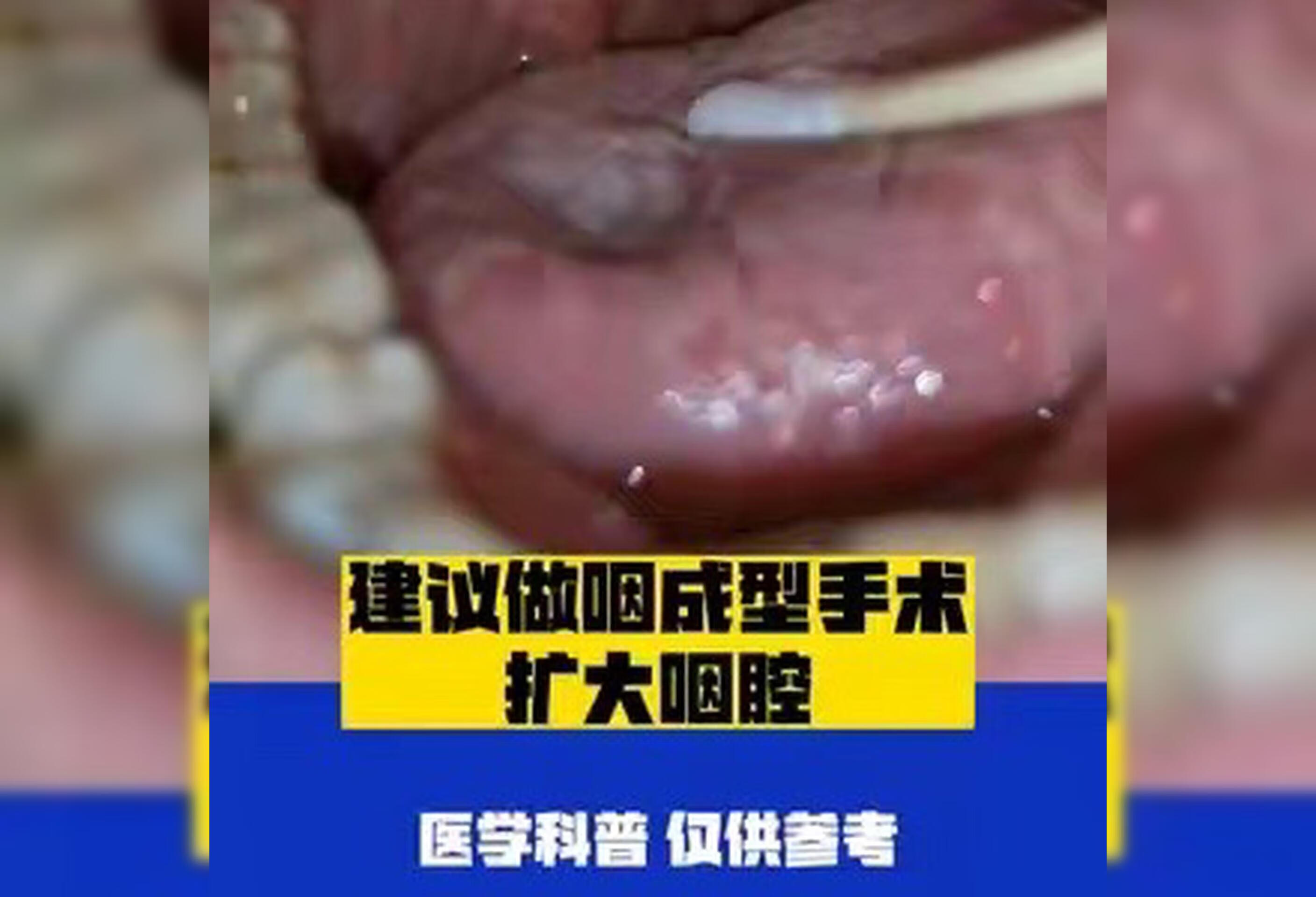 咽腔狭窄导致打呼噜！