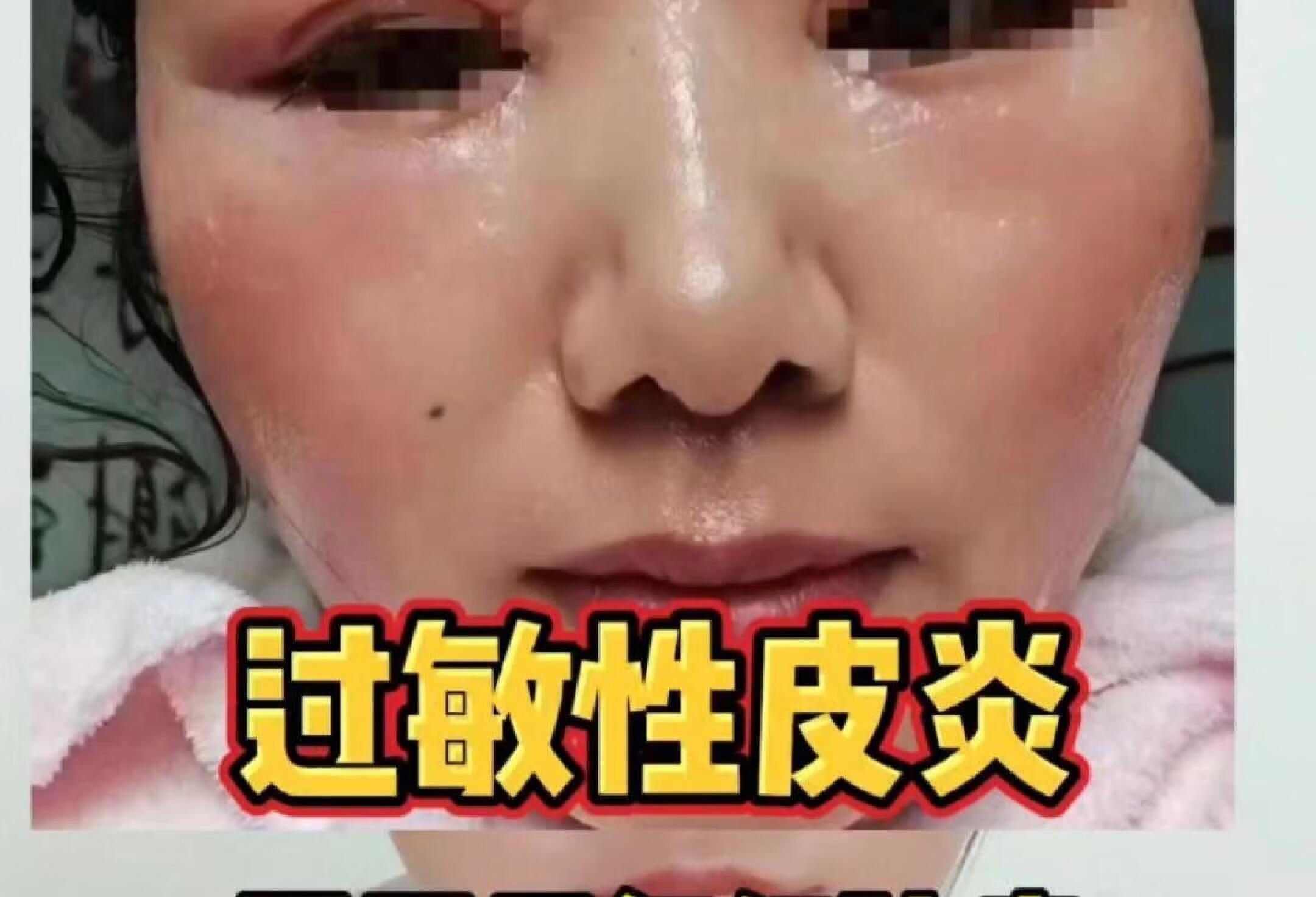 过敏性皮炎反复红肿痒怎么修护？