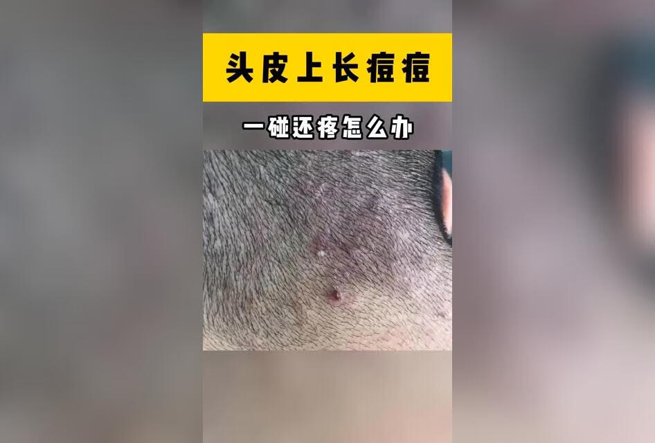 脸上不冒痘，头上却冒个不停，一碰还疼怎么办？