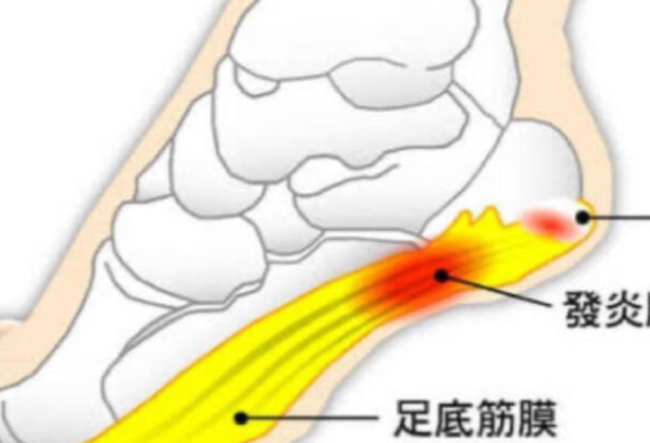 足底筋膜炎复健动作，想缓解疼痛就跟着练！