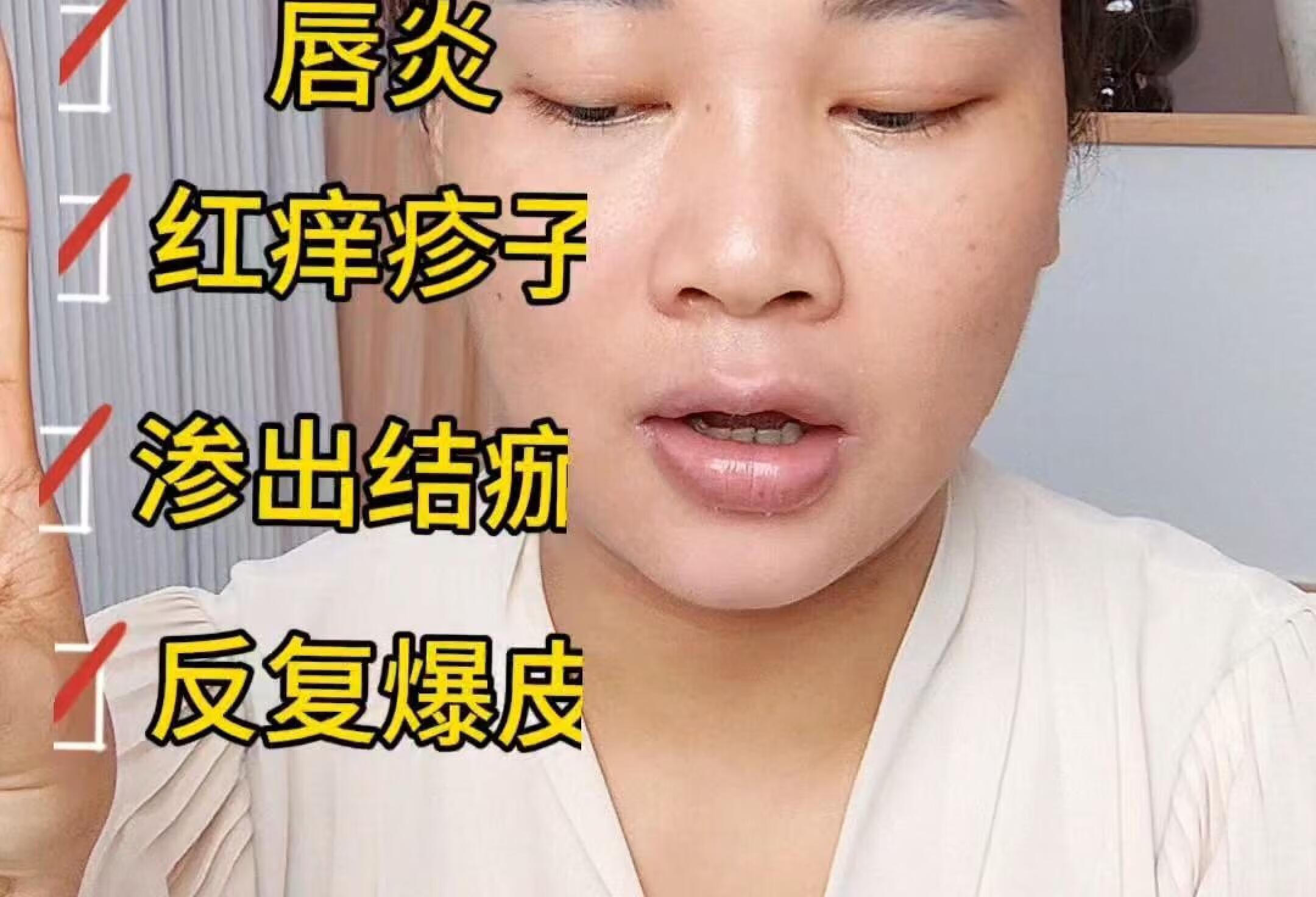 皮炎唇炎ok了