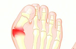 大脚趾出现肿痛是痛风性关节炎吗？