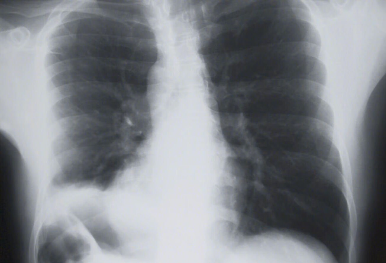 刘懿博士说肺癌（六八八二）低剂量CT筛查肺结节可以，复查差点事