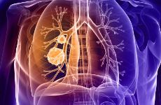 肺癌标志物的临床应用