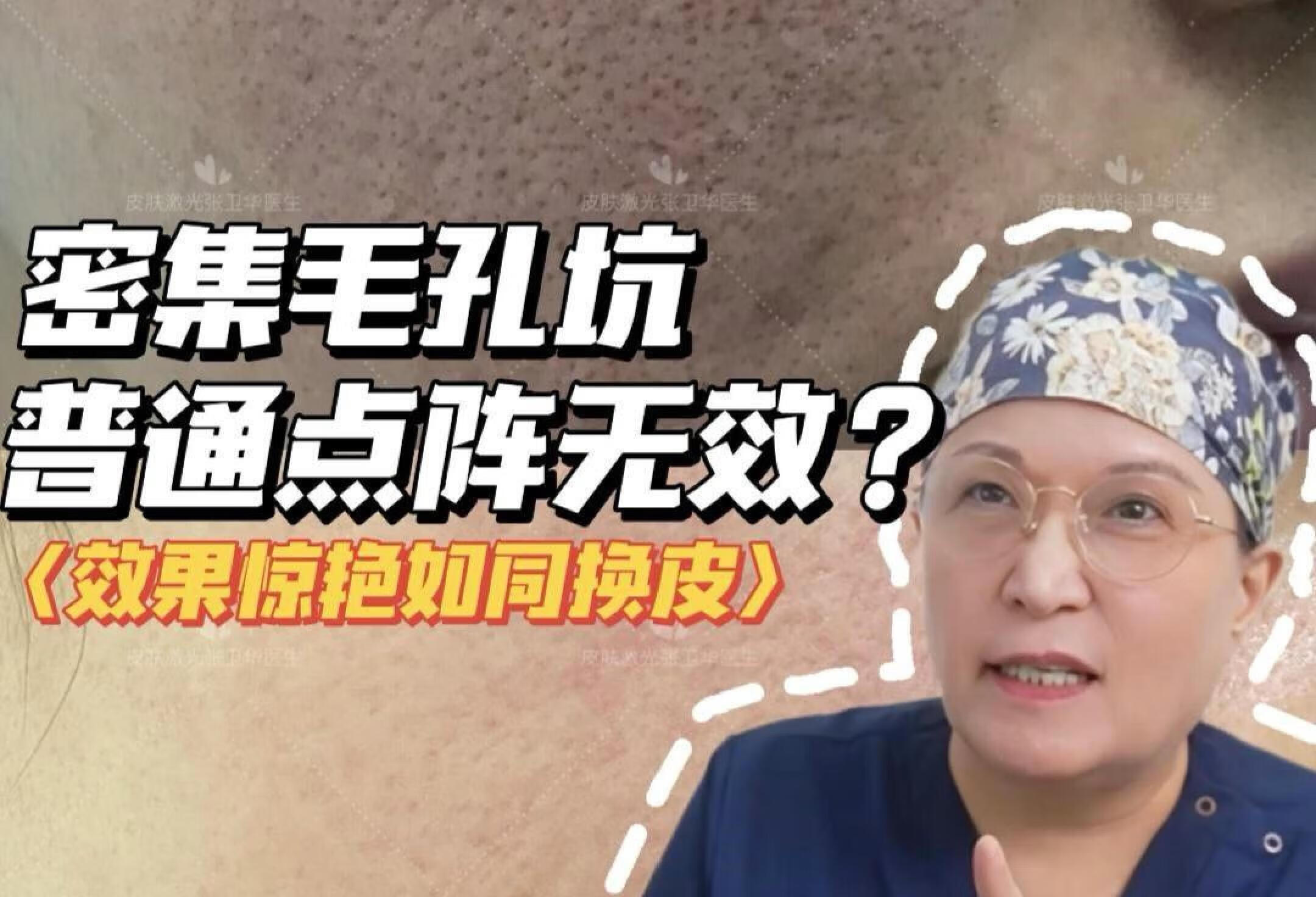 超密集毛孔坑，效果惊艳如同换皮！！！