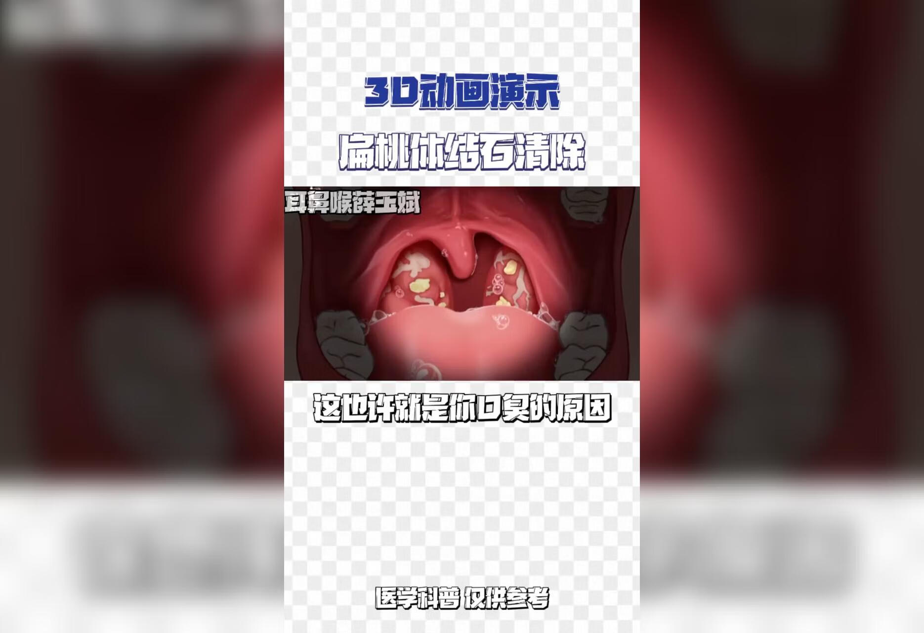 扁桃体结石清除动画演示