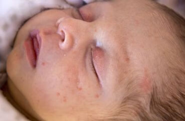 婴儿痤疮的临床表现有哪些