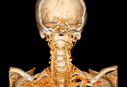 什么样的颈动脉斑块会脱落到脑子里？