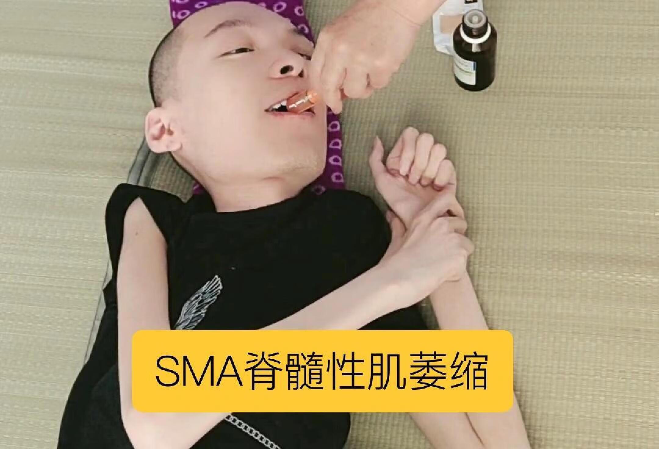 SMA脊髓性肌萎缩