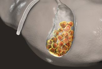 胆囊结石患者会伴有尿频吗？
