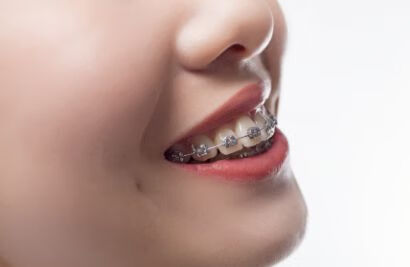 你的牙齿可以通过矫正改善吗？【实例参考】