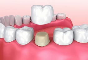 根管治疗之术后牙冠修复的必要性