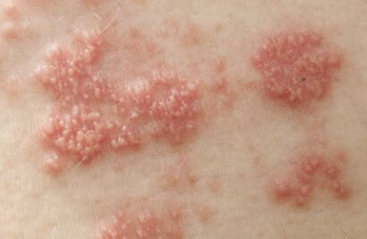 带状疱疹会传染吗？