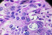 肝门部胆管癌的检查方法有哪些？