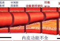 下肢动脉硬化不同时期的症状有什么不同？