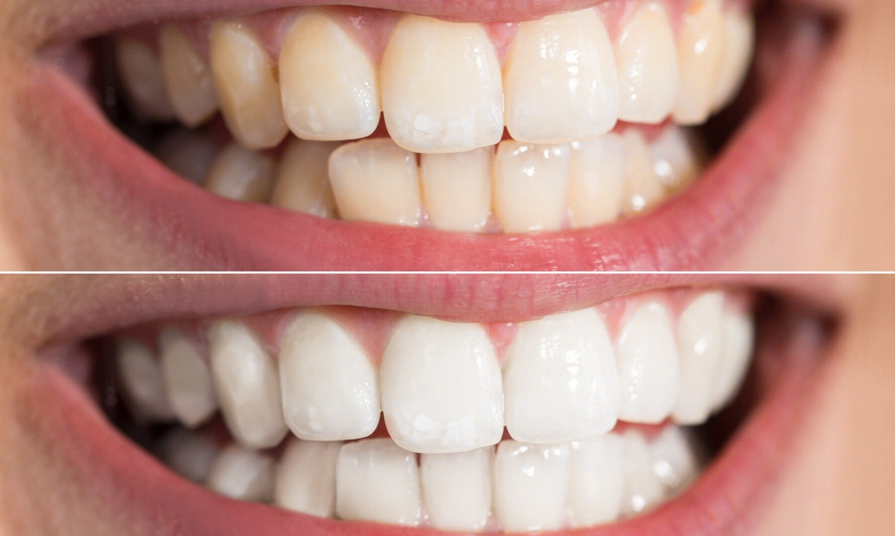 牙齿隐裂的预防和治疗