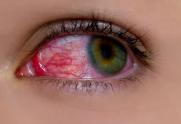患了“红眼病”应注意什么