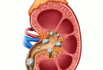 尿石症～肾结石的形成原因及治疗方法