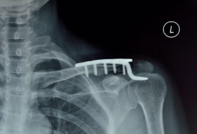 肱骨髁间骨折的非手术治疗