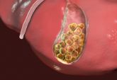 肝内胆管结石如何确诊？