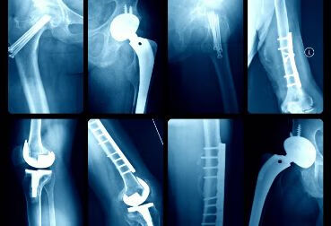 骨折患者最害怕的病——“骨髓炎”，到底该如何预防？