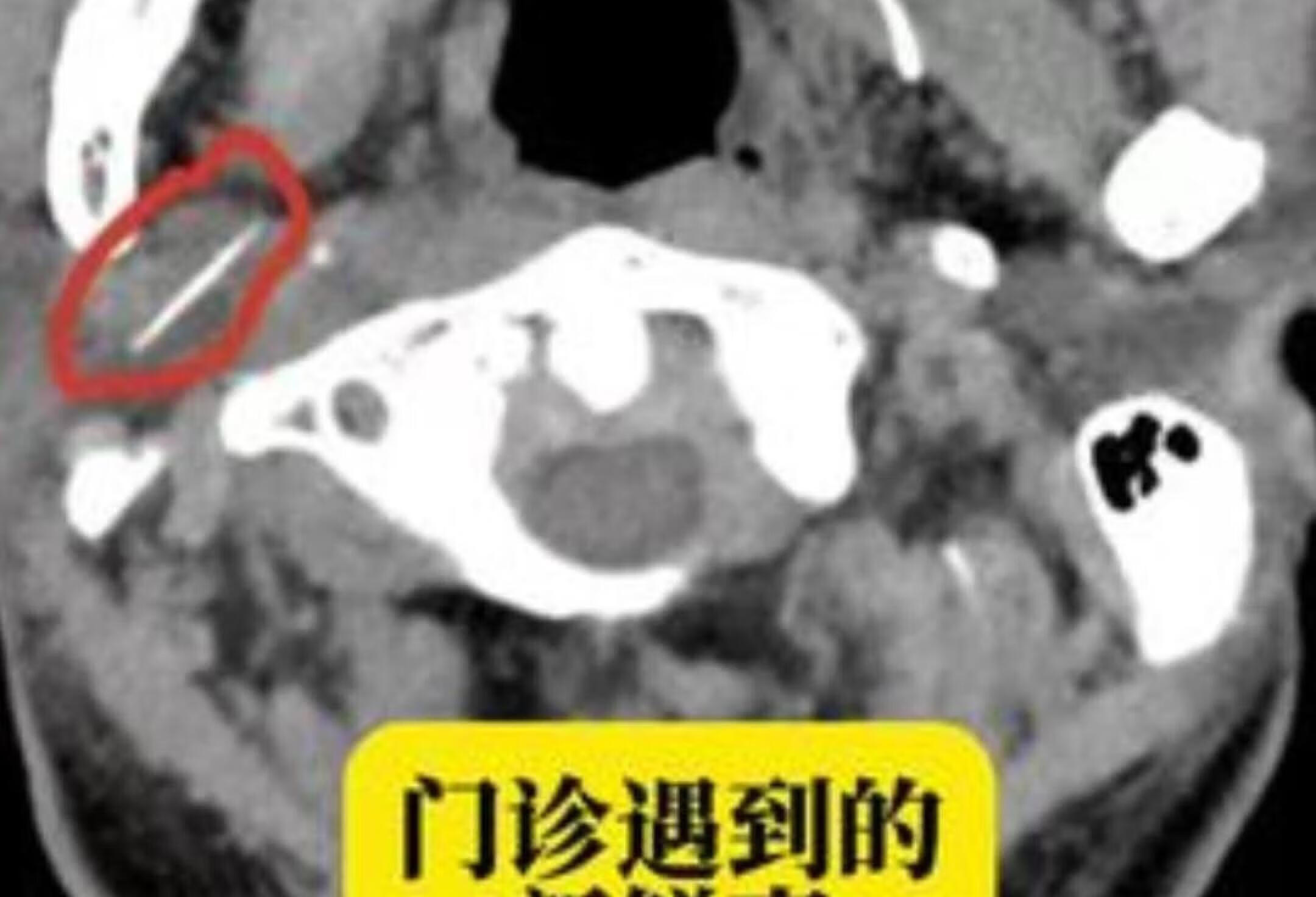 门诊趣事：解决各类颈椎问题方法