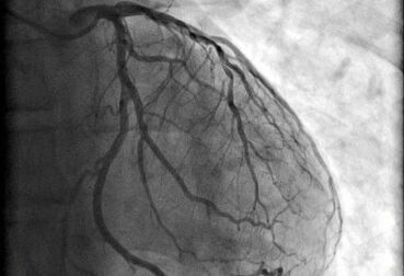 家庭医生科普之冠状动脉介入