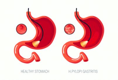 胃肠镜检查