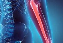 肱骨外髁骨折的临床表现及诊断
