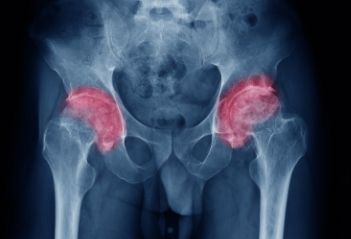 股骨转子间骨折的临床表现与诊断