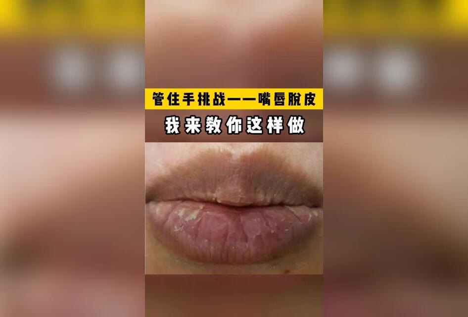 管住手挑战，嘴唇脱皮，我来教你这样做