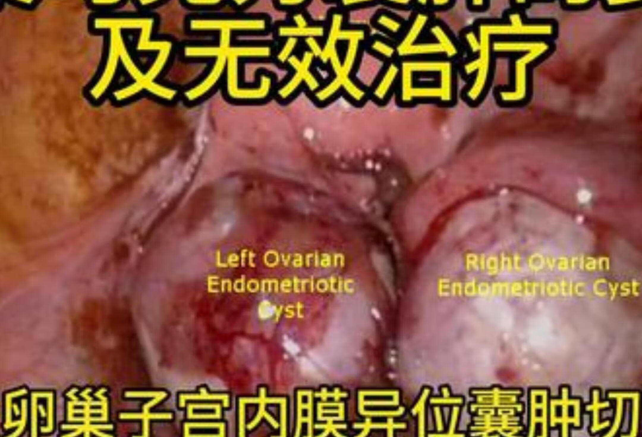 卵巢巧克力囊肿的复发与无效治疗