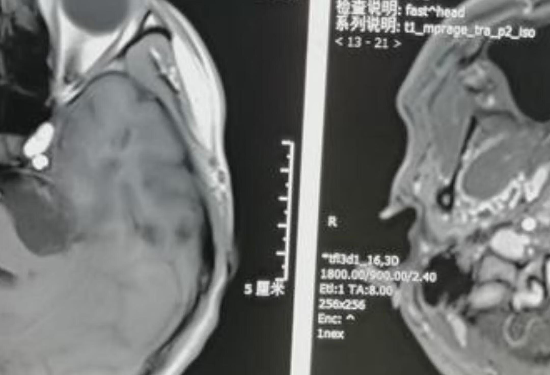 表皮样囊肿医学影像 科普健康知识 放射科 