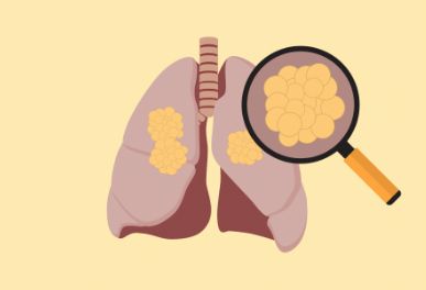 肺癌如何治疗，取决于它的类型和分期