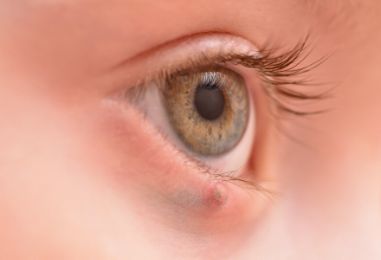 眼睑水肿是正常现象吗？