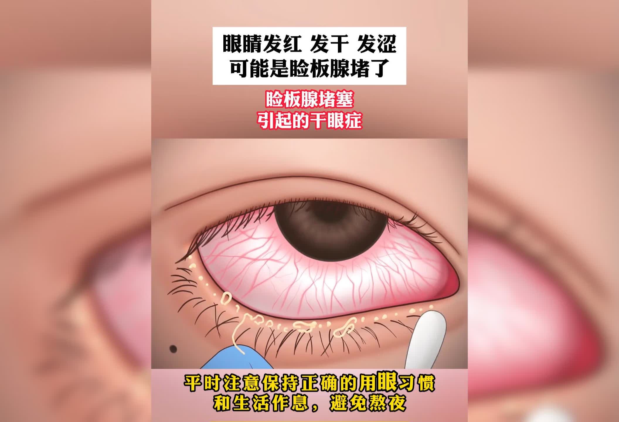 山东菏泽市视光中心睑板腺炎治疗经验分享