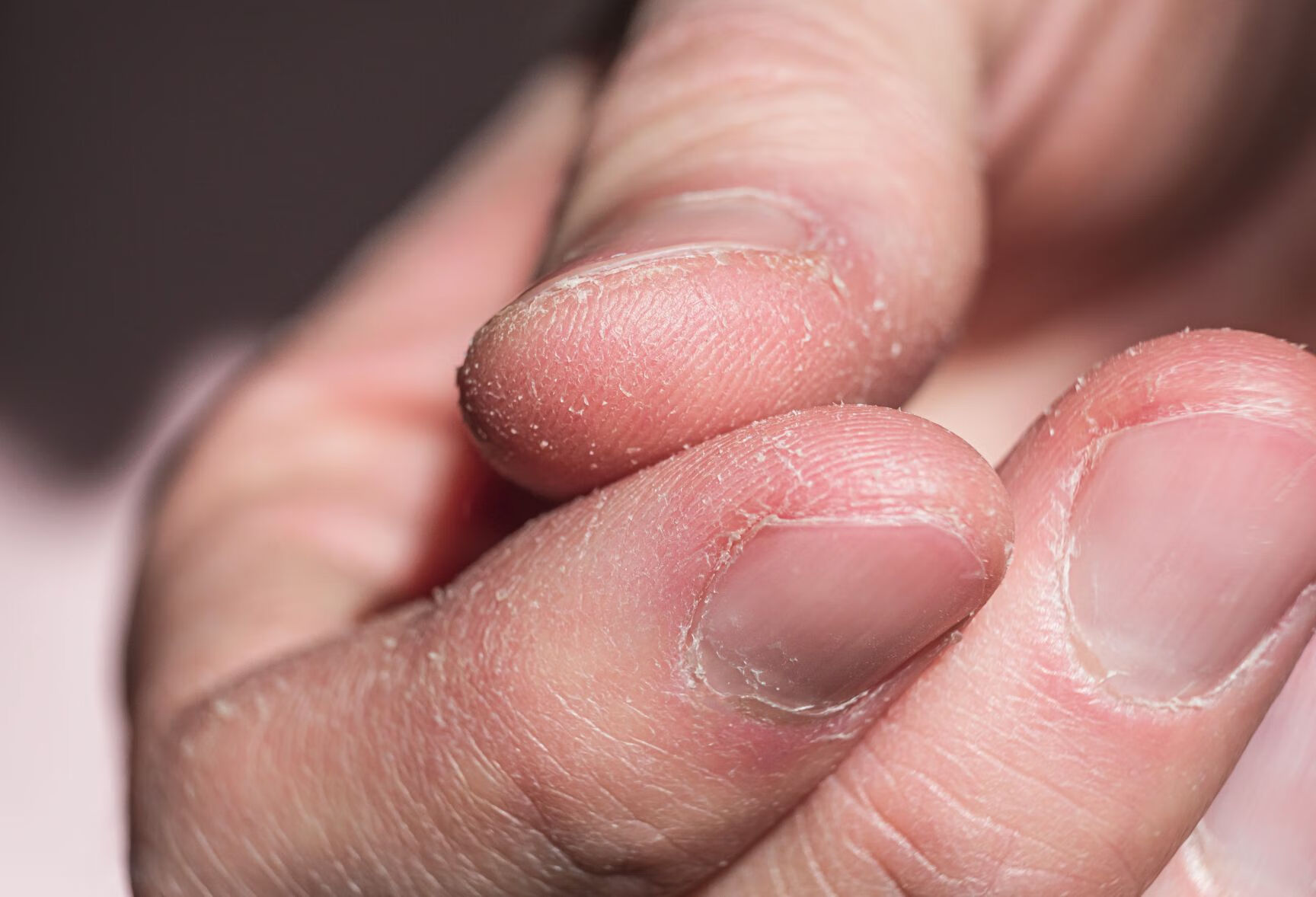 手反复脱皮，剥脱性角质松解症是什么？