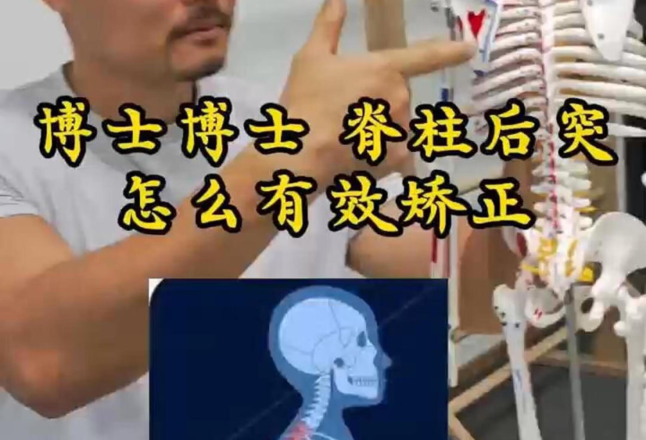 脊柱后凸怎么有效矫正