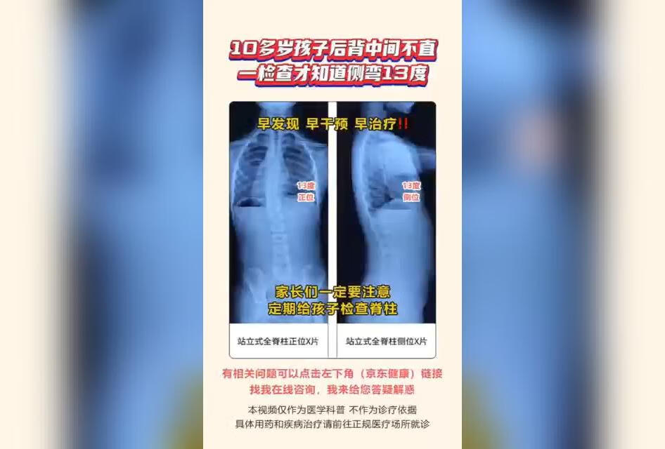 脊柱侧弯，早发现，早干预，早治疗