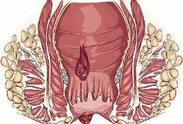 痔疮如何预防与保健？