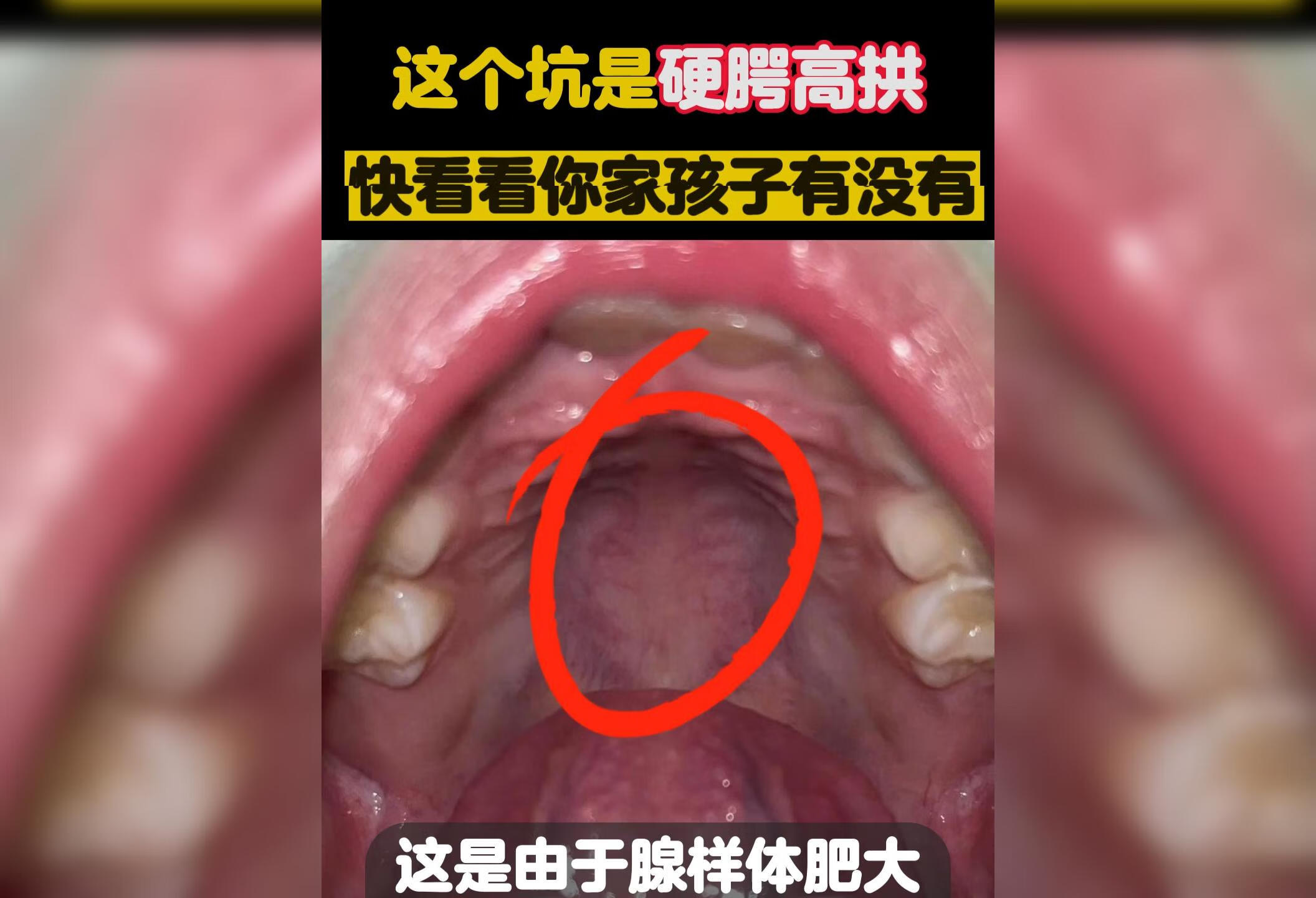 张嘴呼吸致使硬腭高拱会变丑