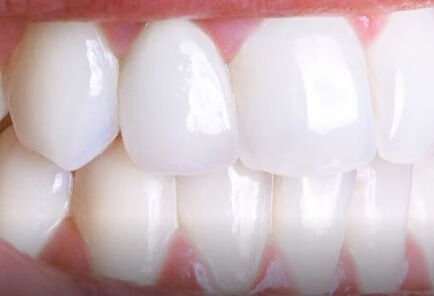 牙齿脱落需要注意什么？
