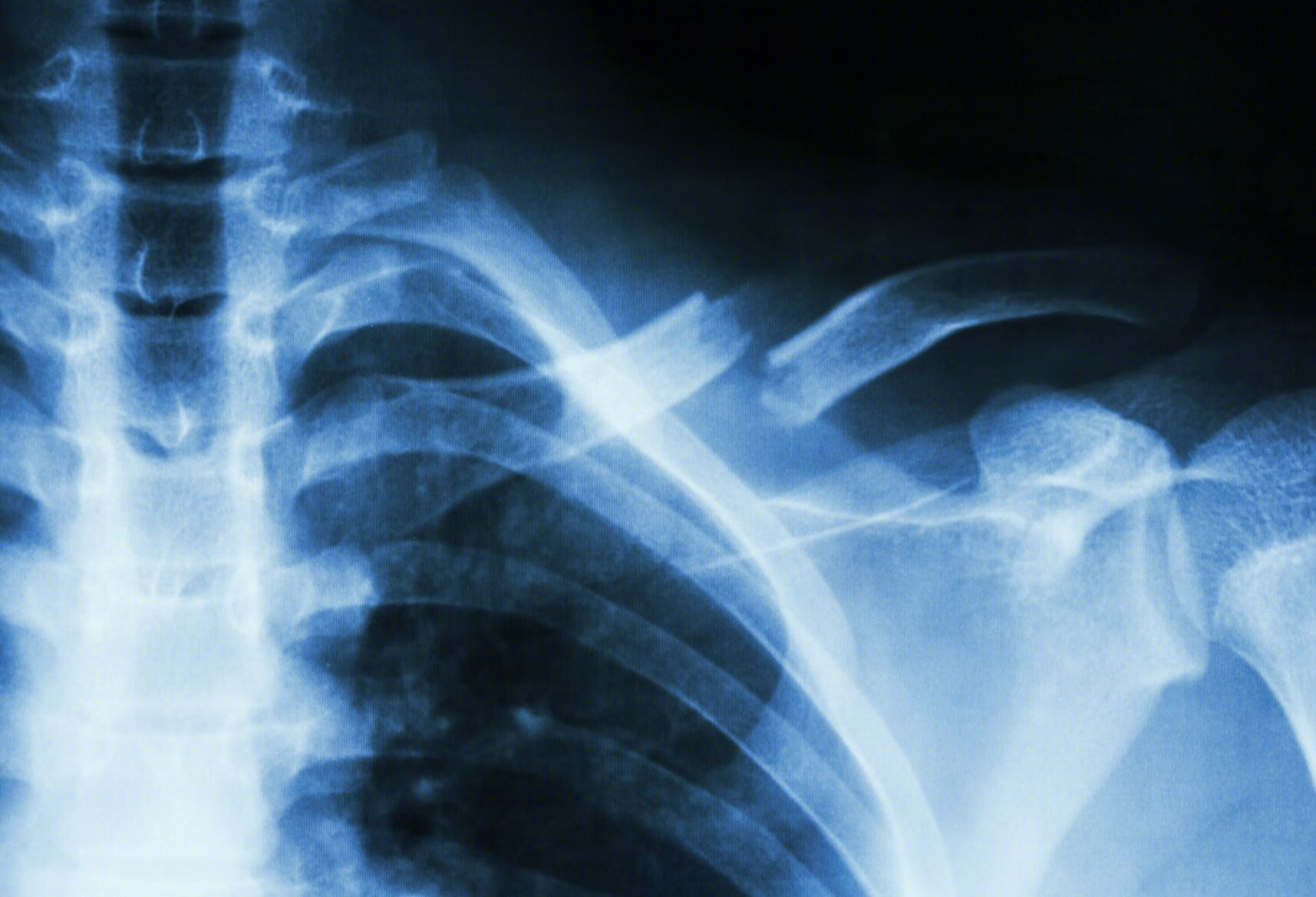 胸椎骨折后注意事项是什么？
