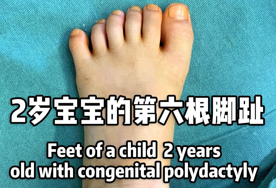 2岁宝宝的第六根脚趾